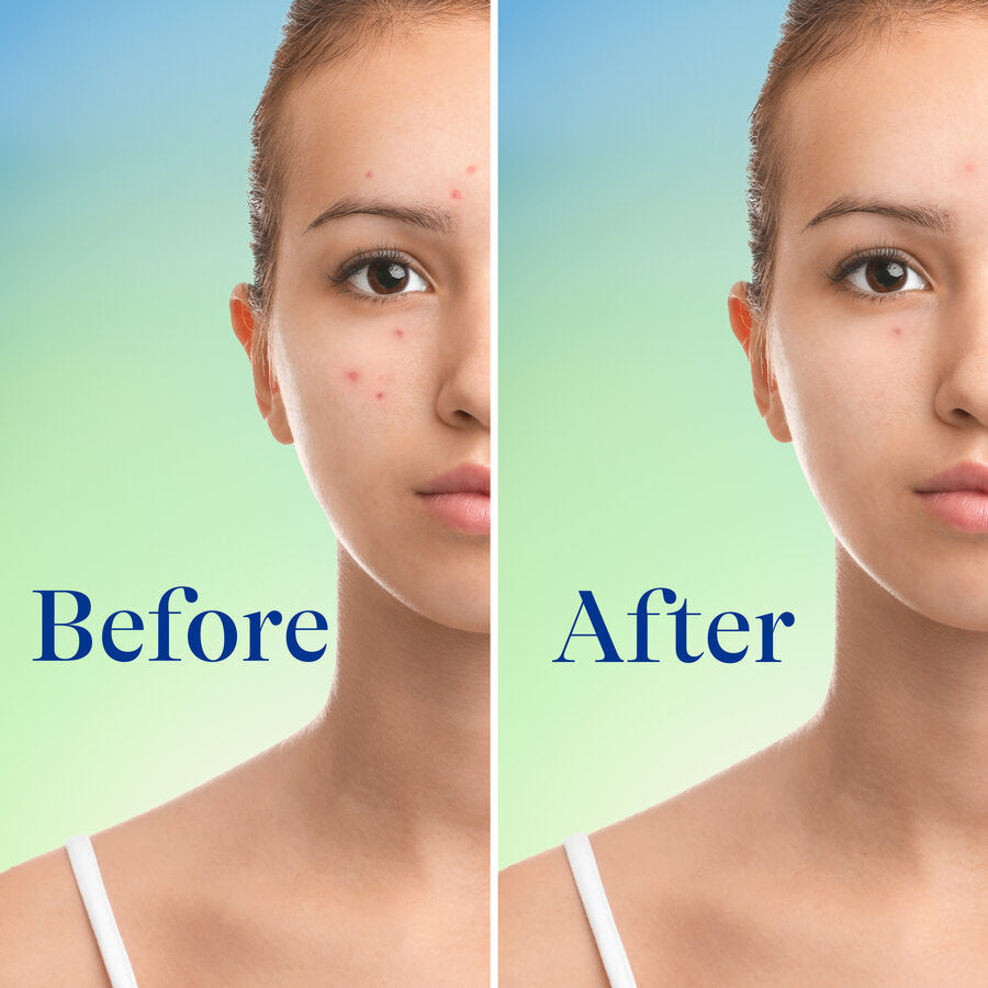 Differin 10% Benzoyl Peroxide Maximum Strength Foaming Cleanser