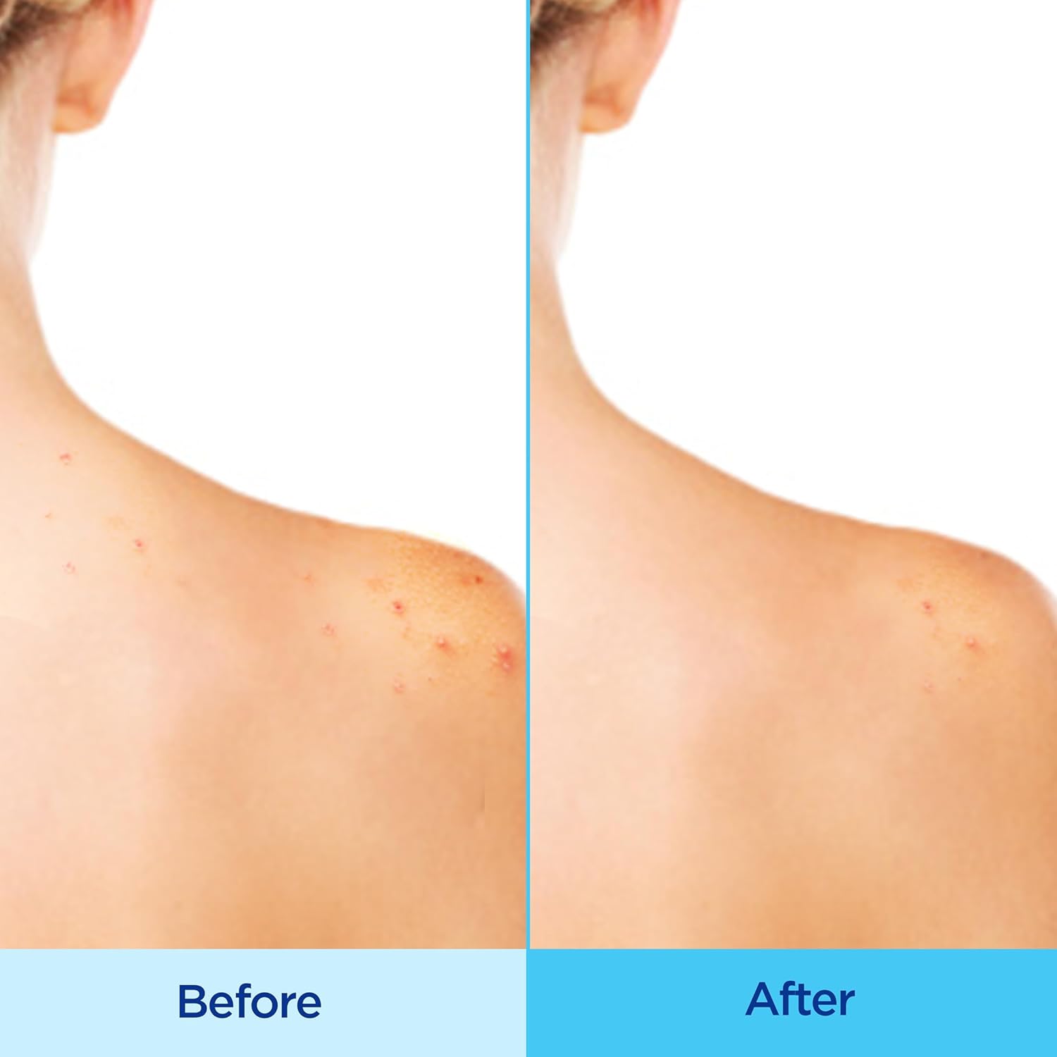 Differin Acne Clearing Body Spray