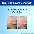 Differin 10% Benzoyl Peroxide Spot Treatment