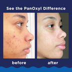 PanOxyl Acne Foaming Wash Maximum Strength 10% Benzoyl Peroxide