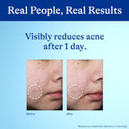 Differin 10% Benzoyl Peroxide Spot Treatment