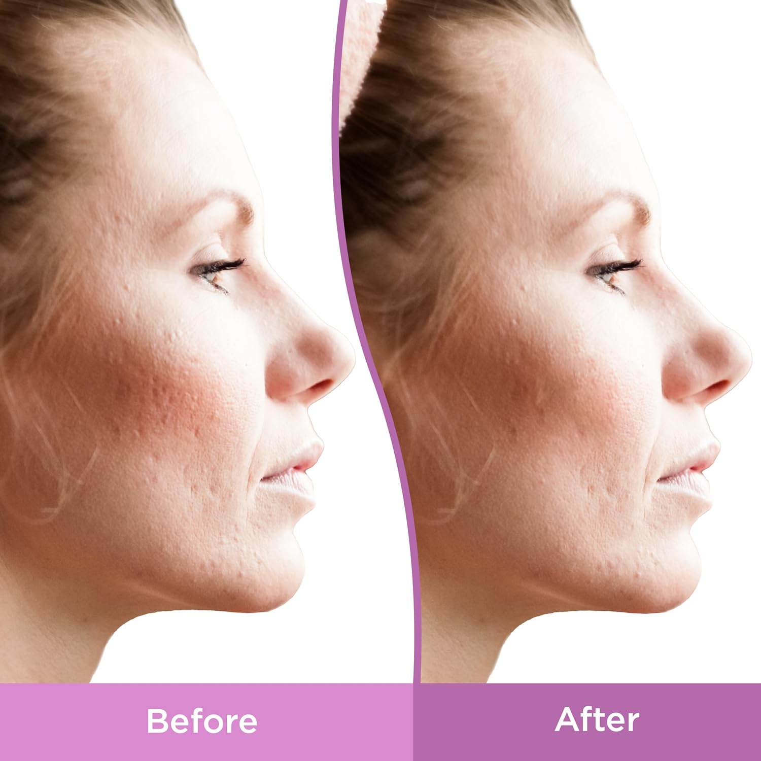 Differin Resurfacing Scar Gel