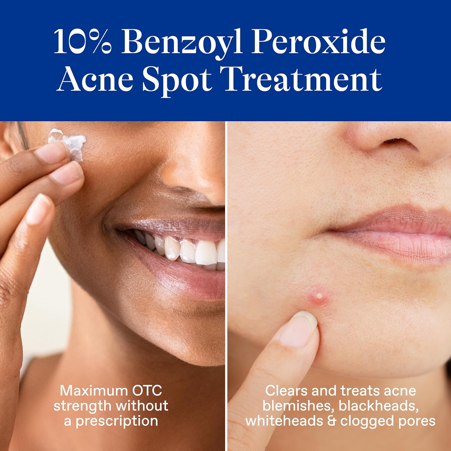 Differin 10% Benzoyl Peroxide Spot Treatment