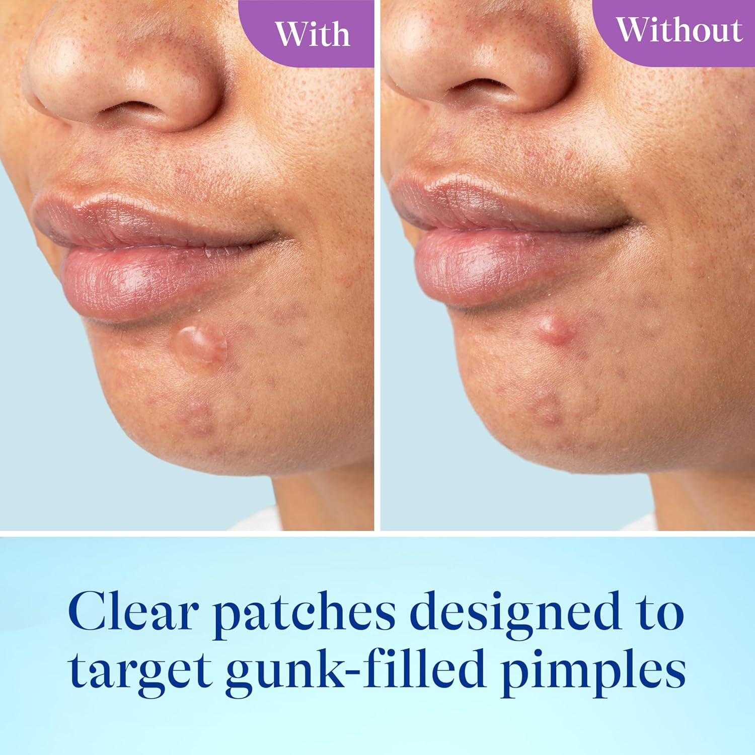 Differin Power Patch Skin Restore Hydrocolloid Pimple Patches