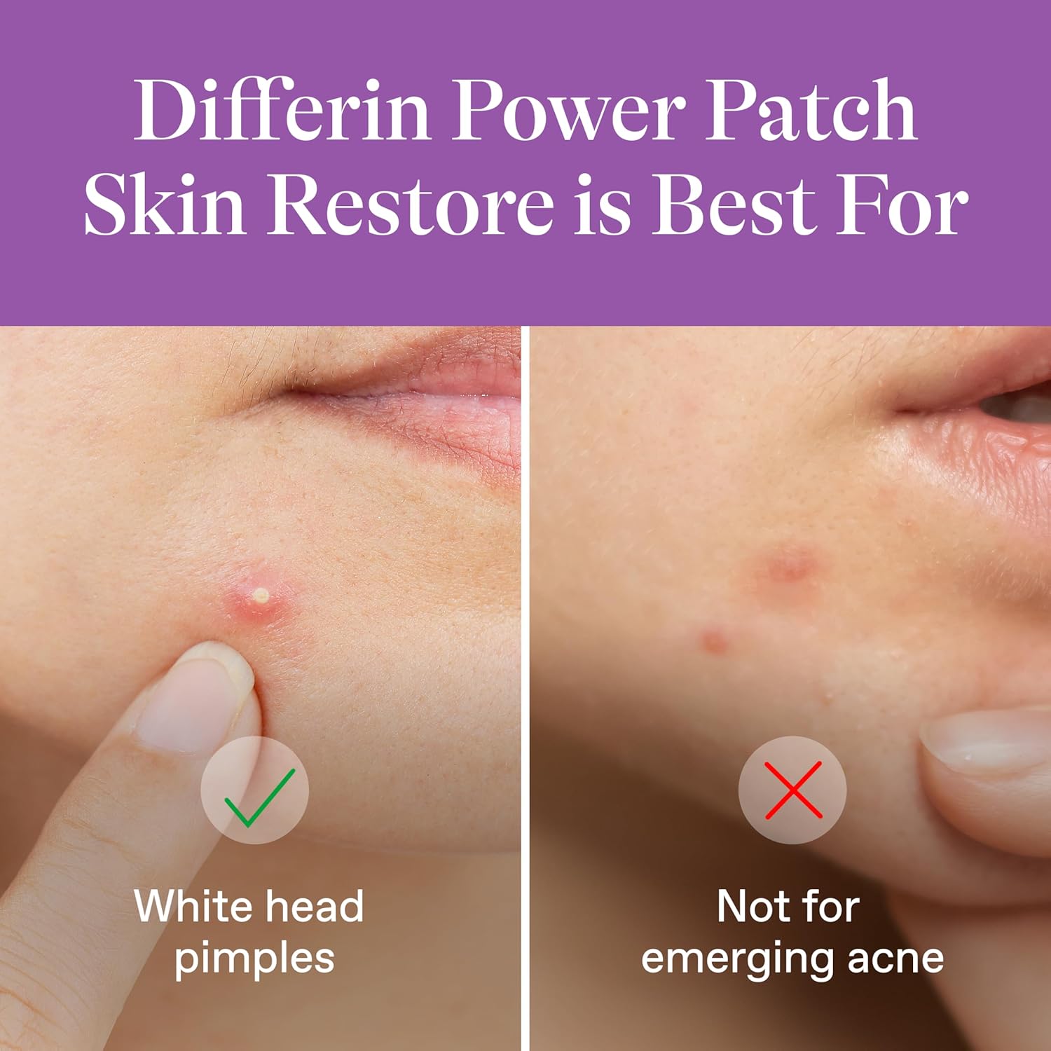 Differin Power Patch Skin Restore Hydrocolloid Pimple Patches