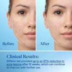 Differin Retinoid Adapalene Gel 0.1%