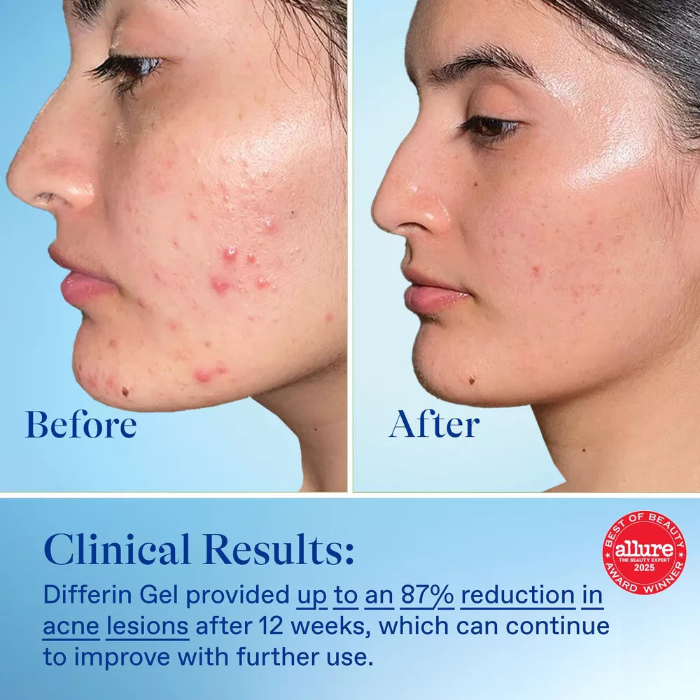 Differin Retinoid Adapalene Gel 0.1%